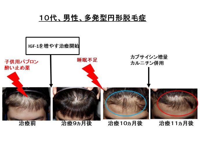 円形脱毛症　病院